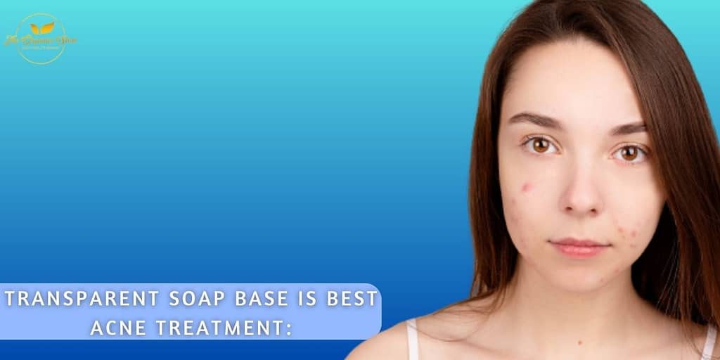 acne treatment home remedies