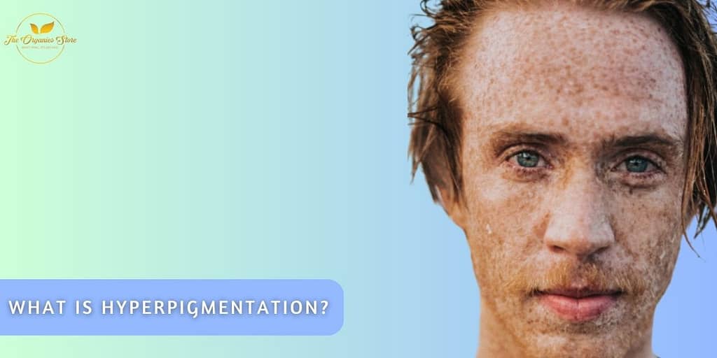 hyperpigmentation treatment on face