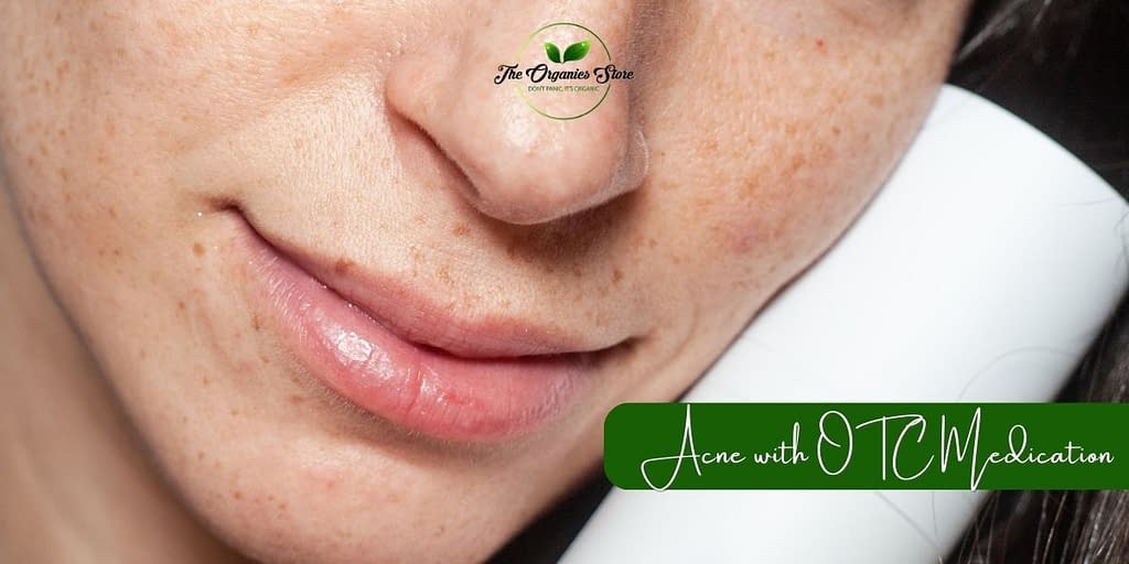 Skincare Routines for Acne Prone Skin