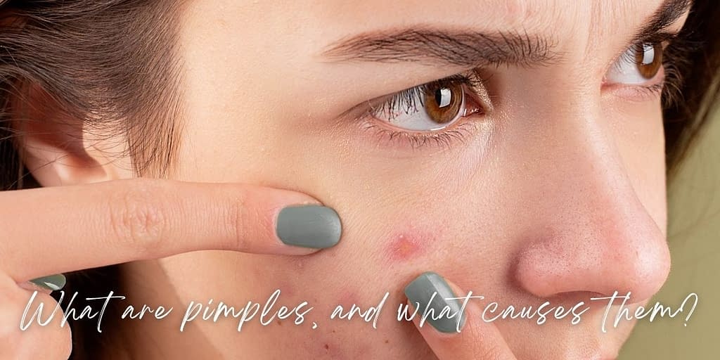 reason for Pimples on Face