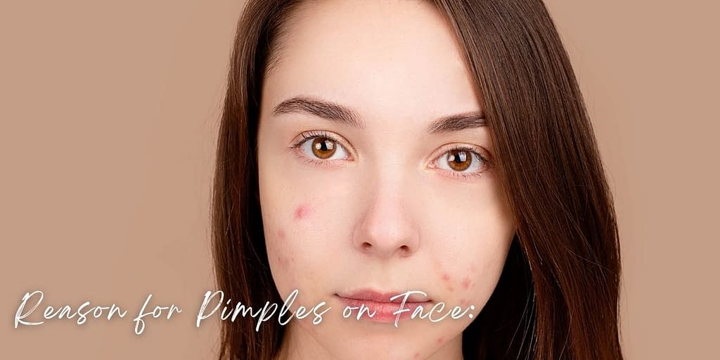 reason for Pimples on Face